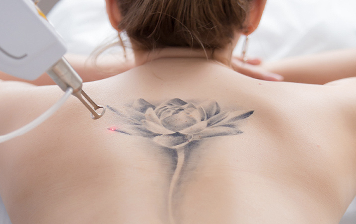 Laser Tattoo Removal